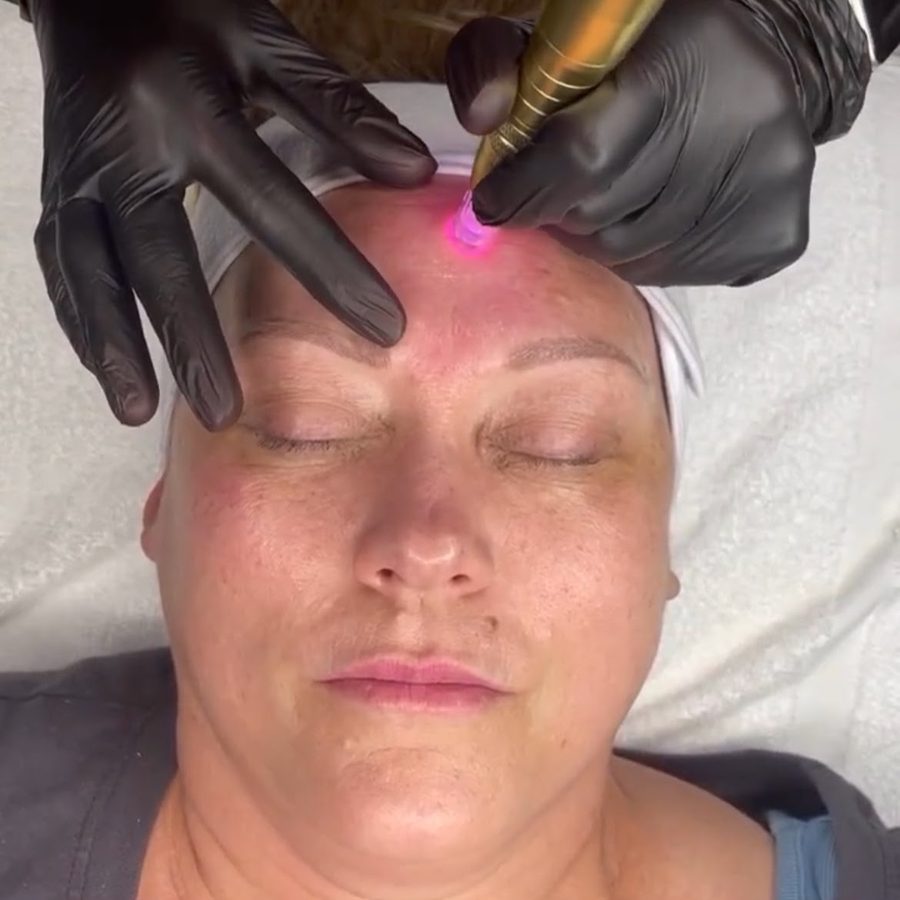 AZS Microneedling Facial collagen boost treatment at Awaken Zen Spa in Mesa, Arizona